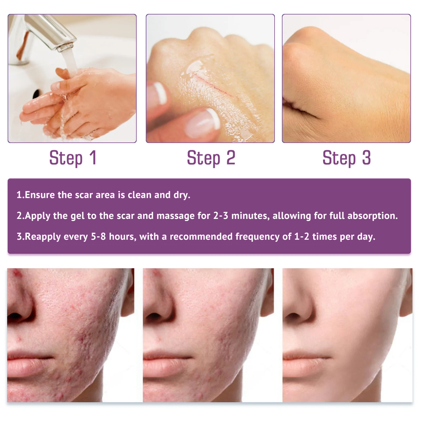 【Limited time discount sale🔥】 Advanced Scar Gel-🏆 Specialized for keloid management🏆